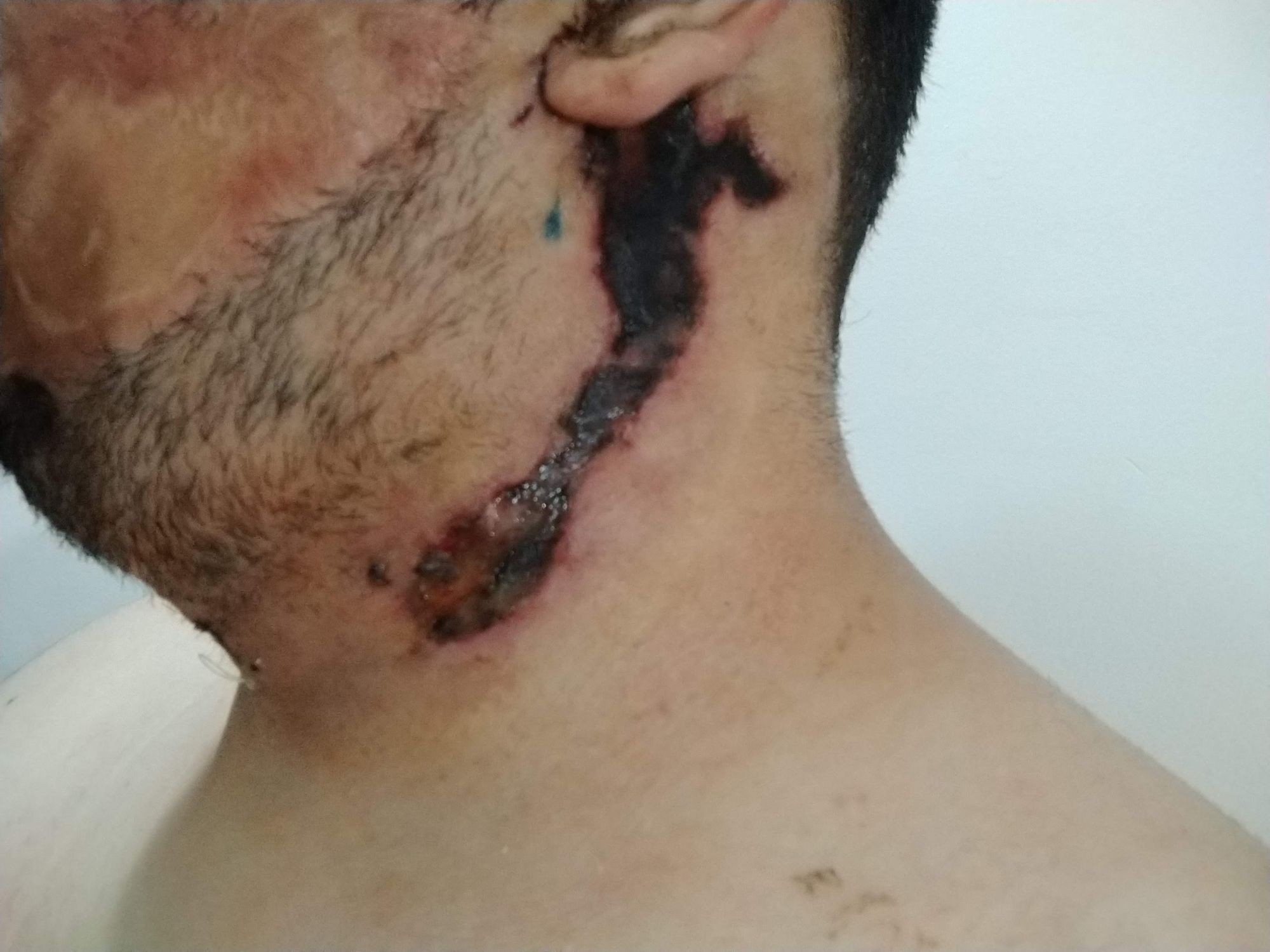 Cirurgia Plástica - expansor de tecido