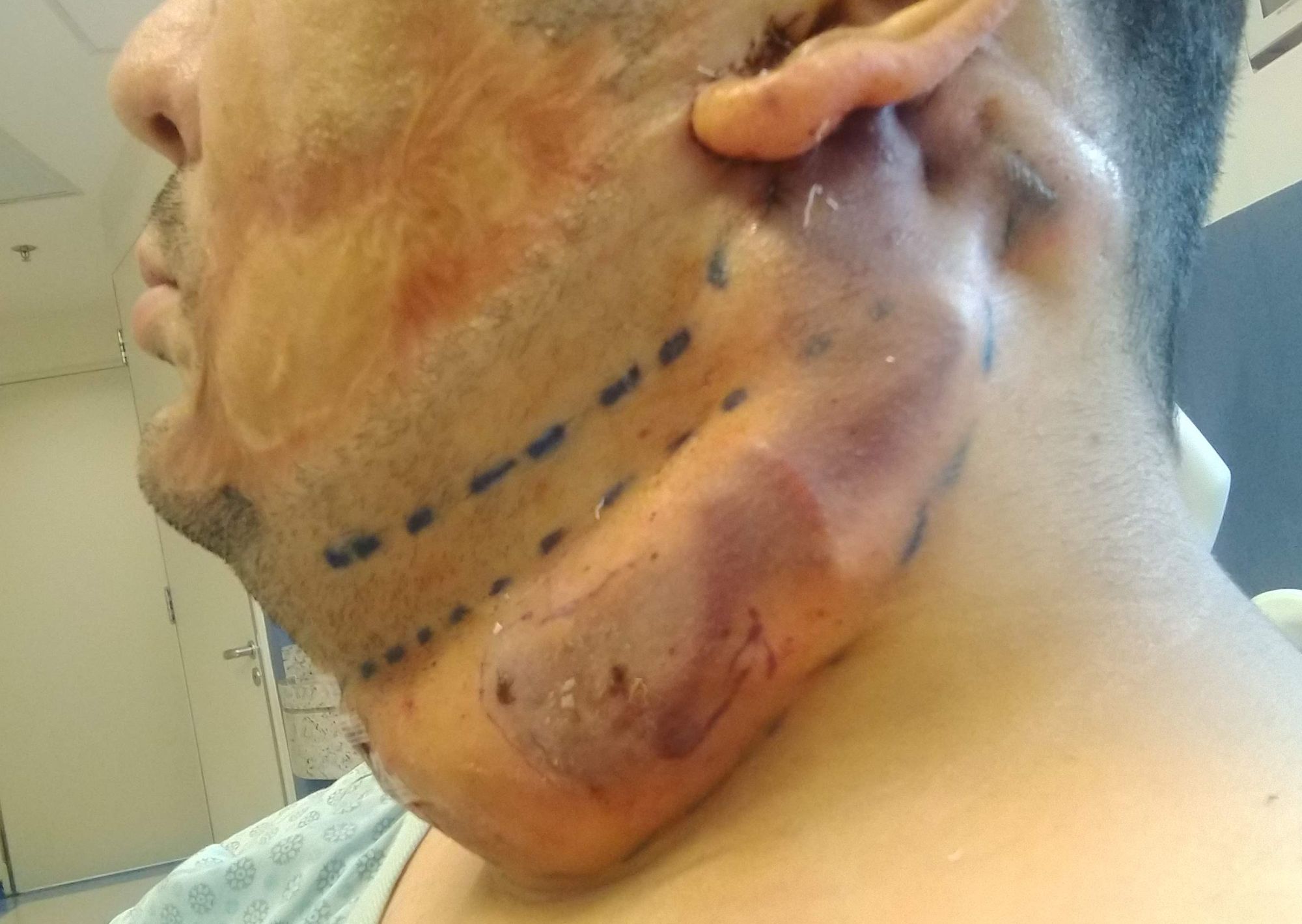 Cirurgia Plástica - expansor de tecido