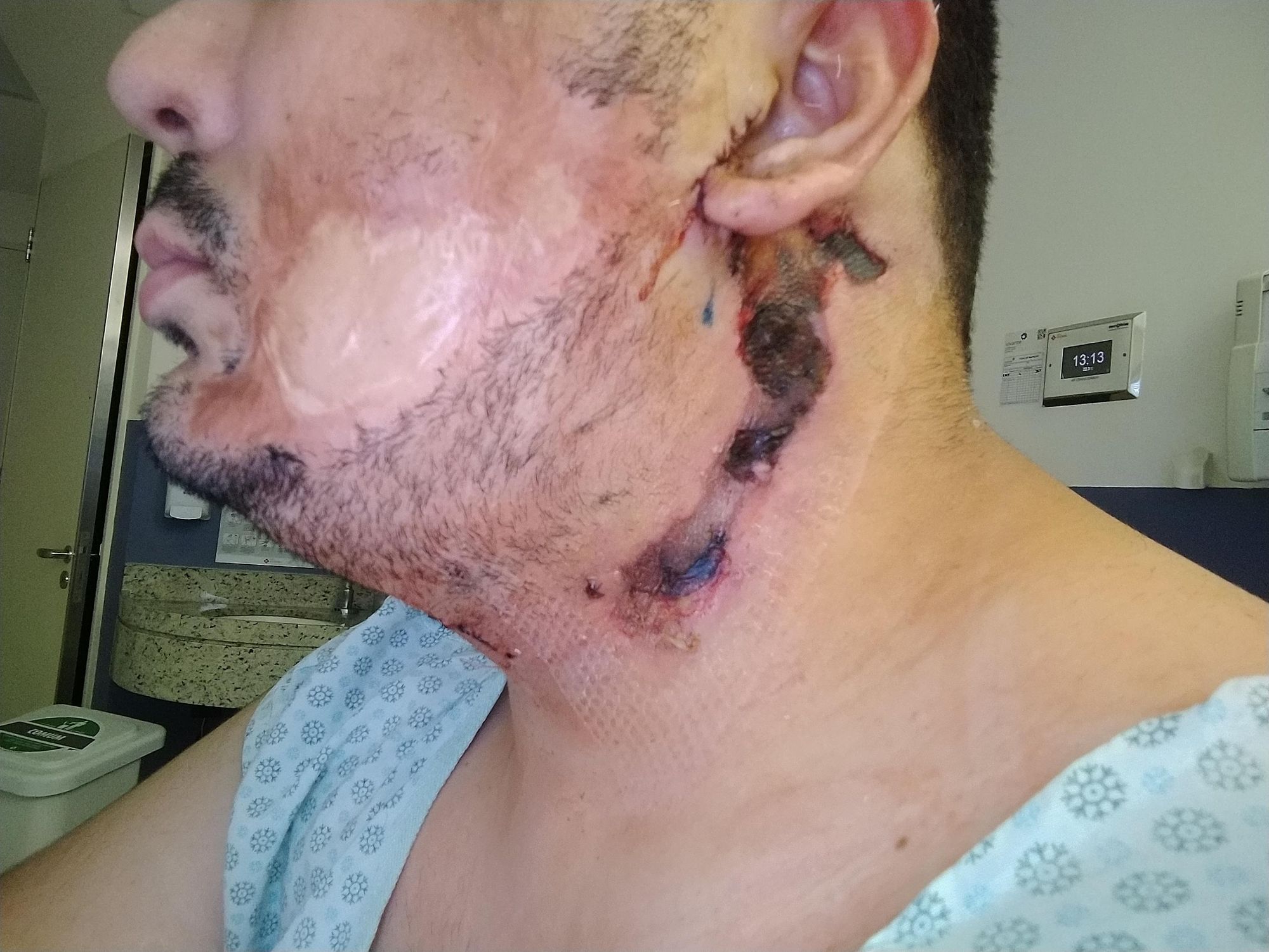 Cirurgia Plástica - expansor de tecido