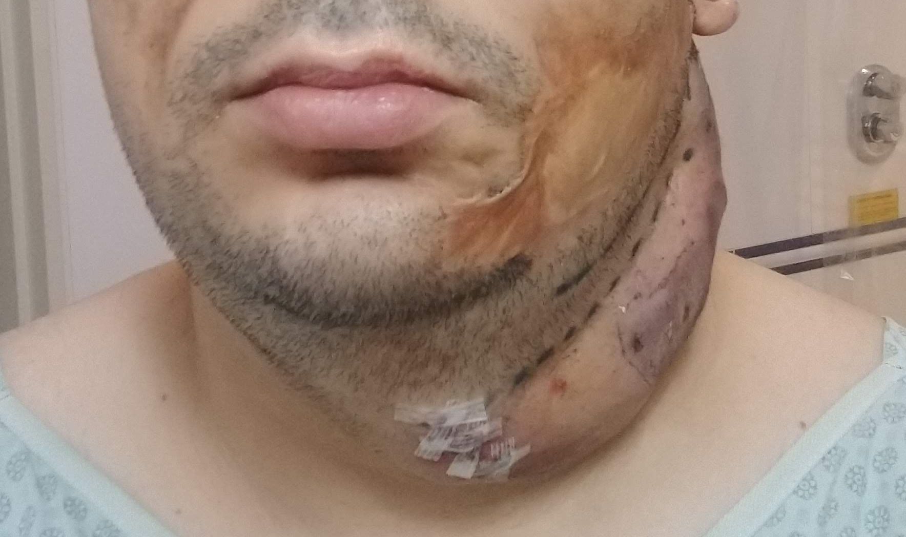 Cirurgia Plástica - expansor de tecido