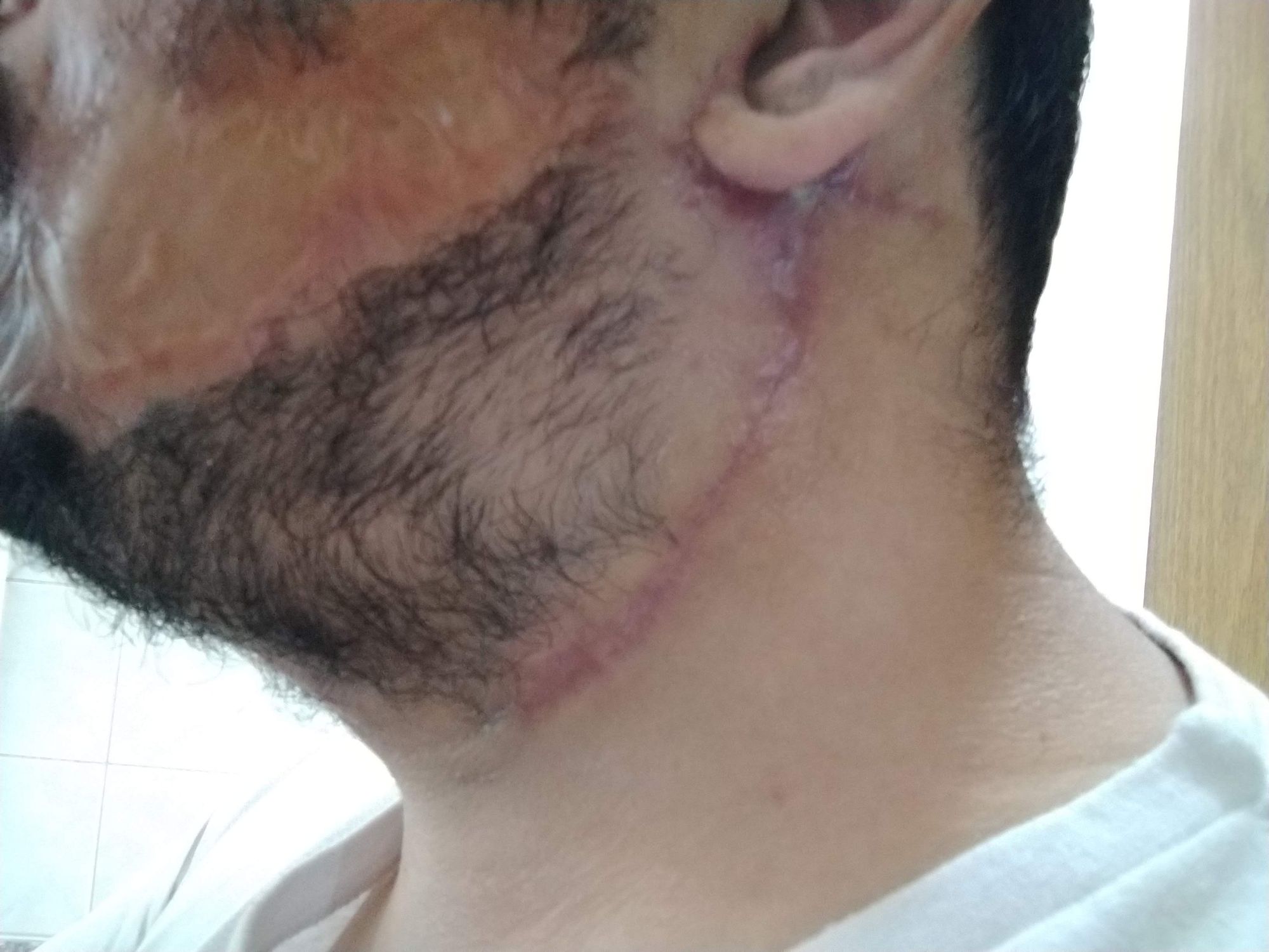 Cirurgia Plástica - expansor de tecido