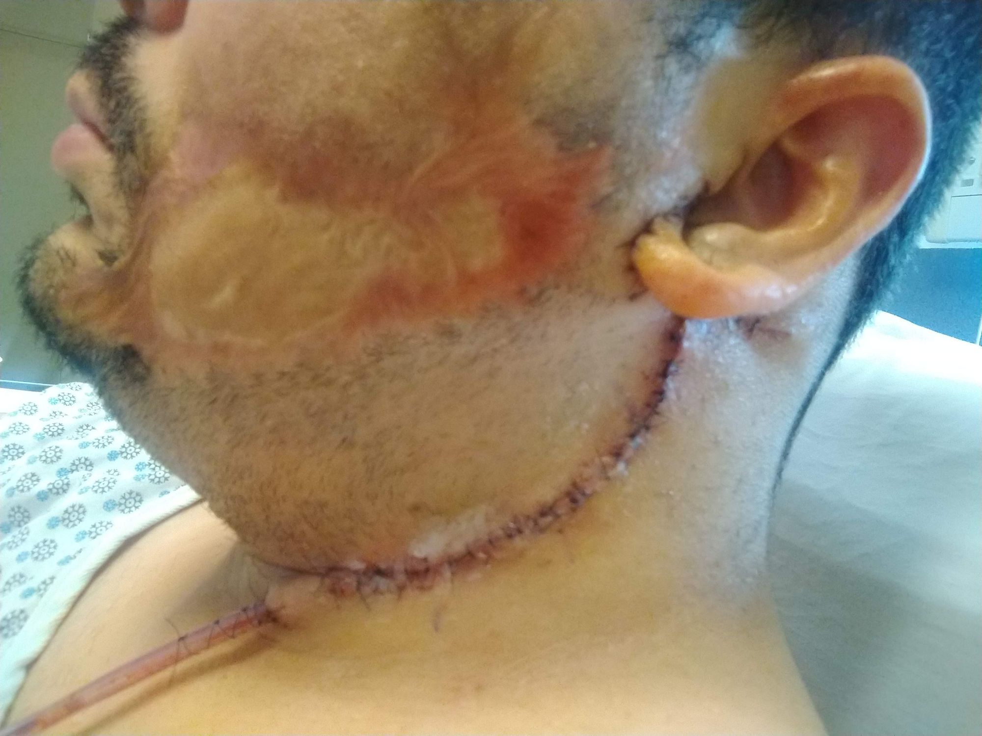 Cirurgia Plástica - expansor de tecido